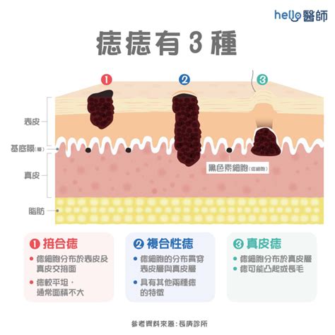 右下巴痣長毛|痣變大、痣多或長毛會變皮膚癌？認識痣的形成與原因